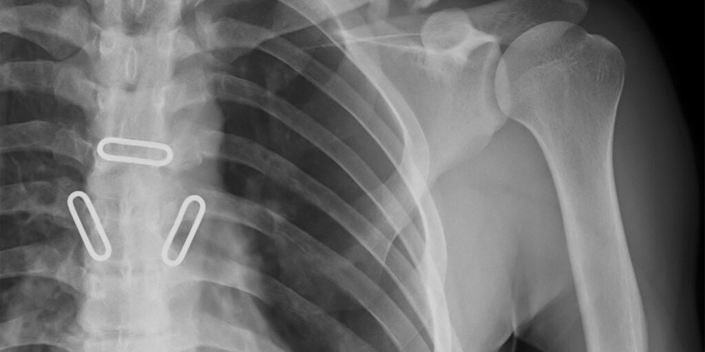 an X-ray showing special damages from a car accident