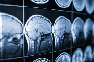 Brain scan on injury